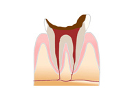 C4（歯質が失われた虫歯）