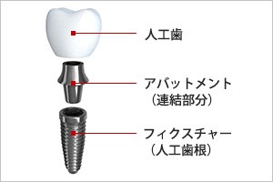 implant_img001